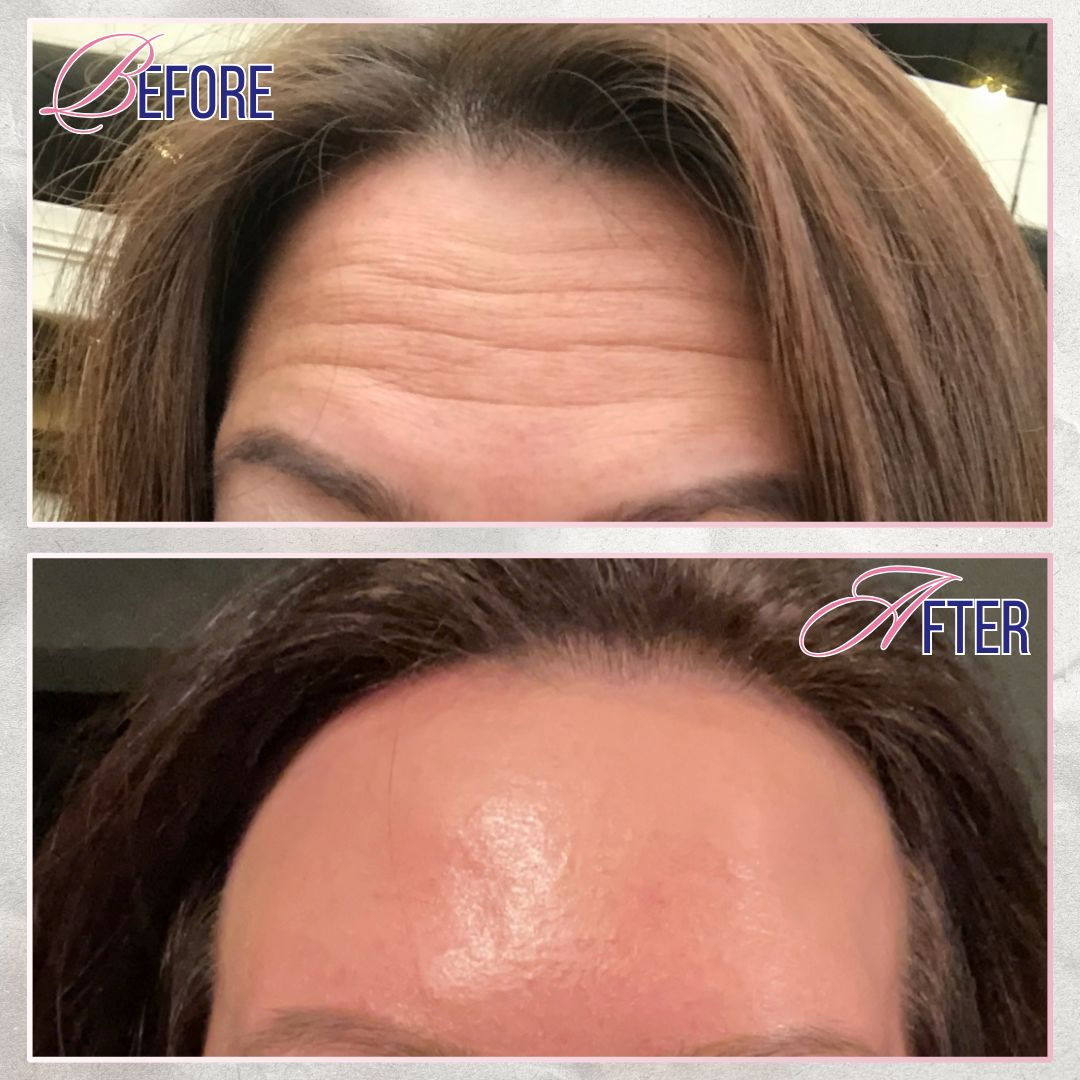 Xeomin before and after softening forehead lines at Shaperz Elite Wellness in Chicago