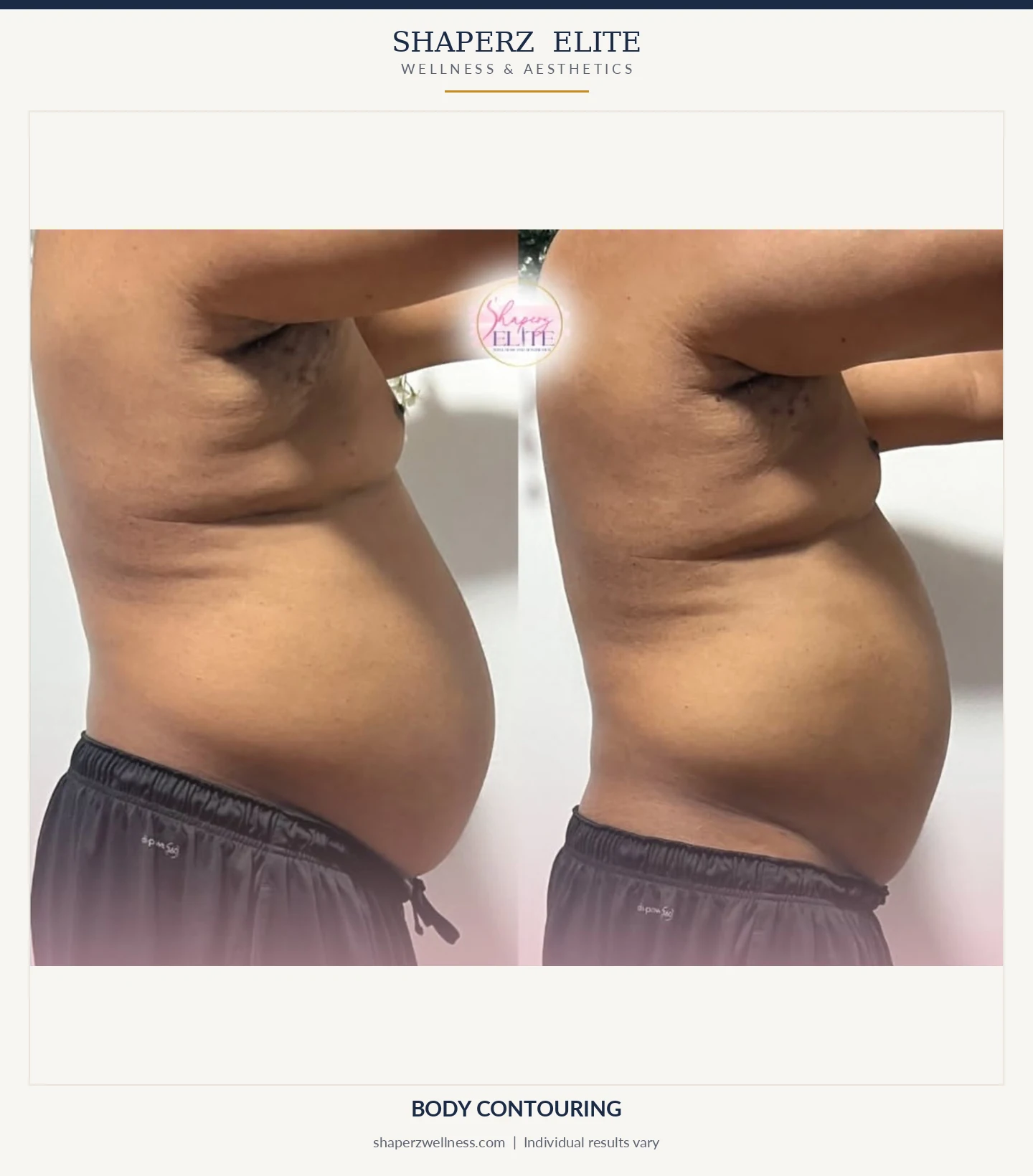 Body contouring before and after, side view of the stomach, at Shaperz Elite Wellness in Chicago