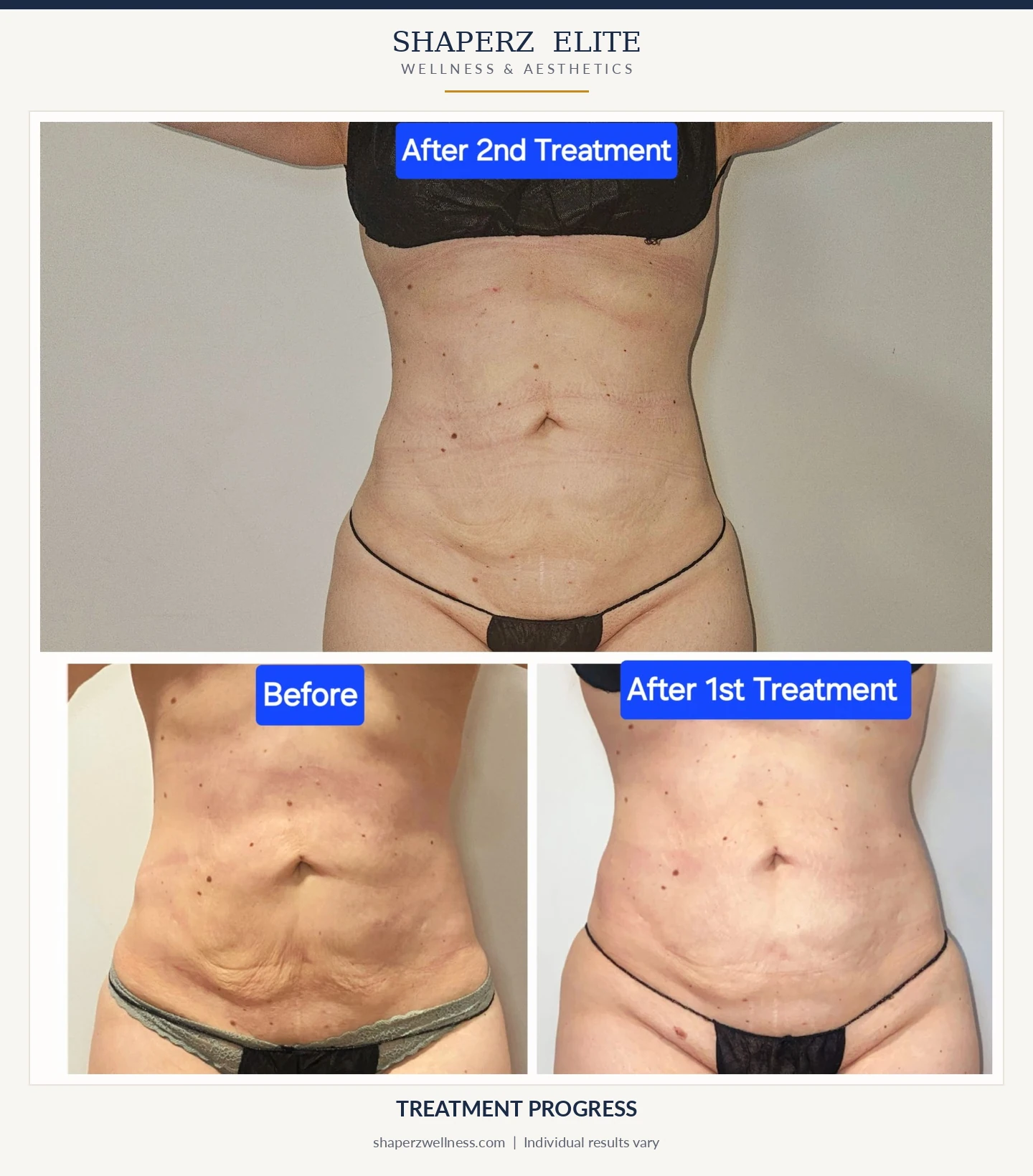 LipoDissolve before, after first and after second treatment at Shaperz Elite Wellness in Chicago