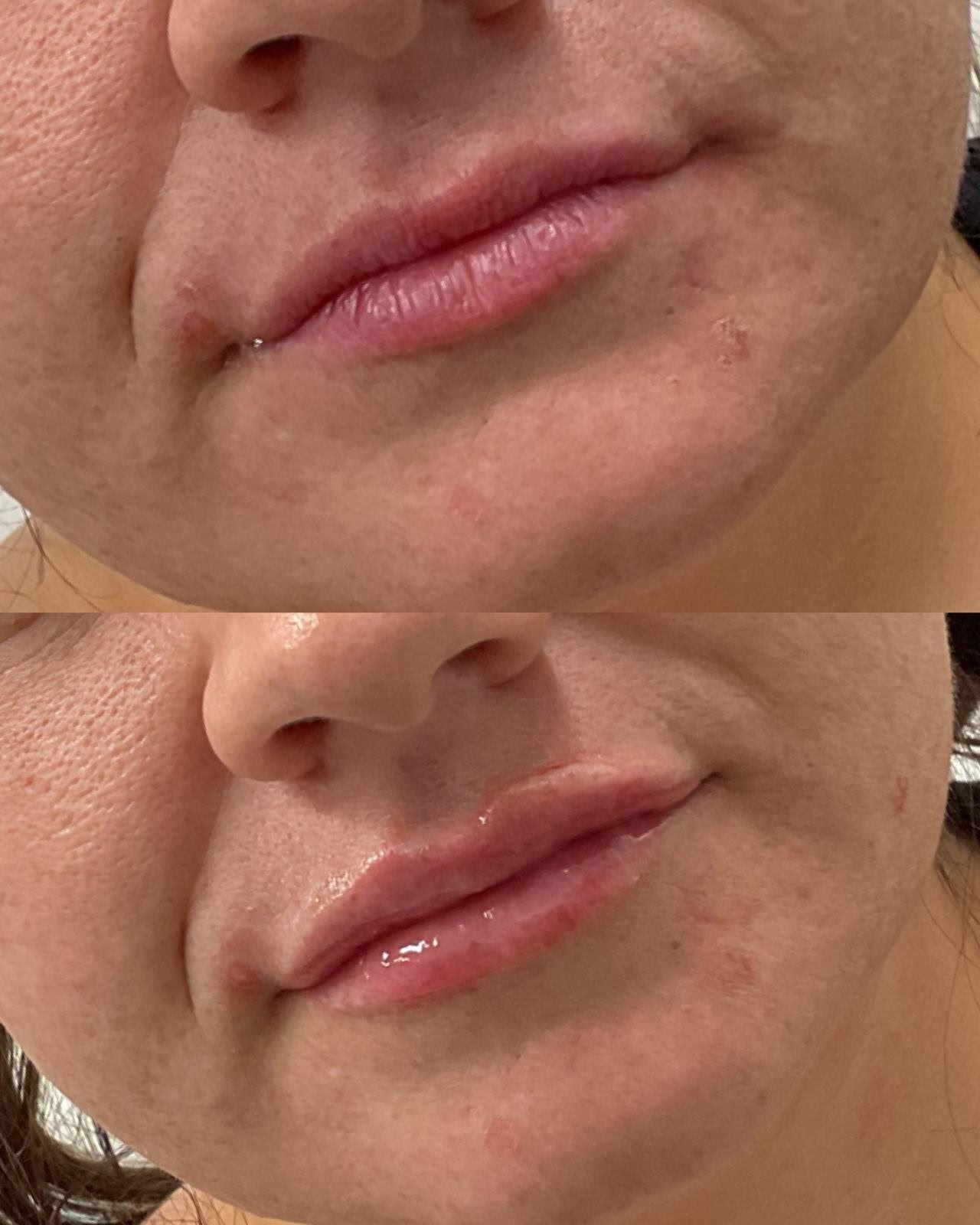 Lip filler before and after at Shaperz Elite Wellness in Chicago