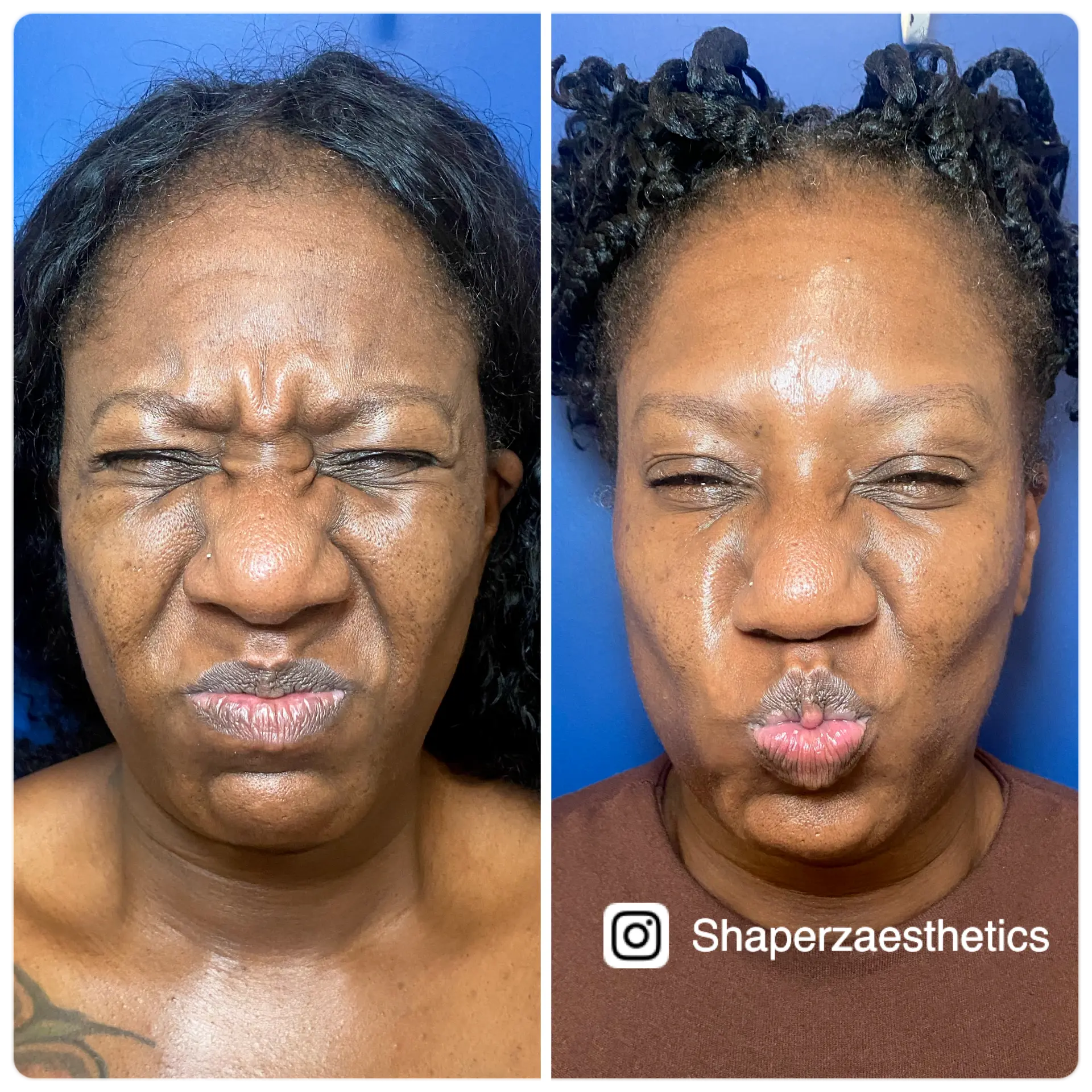 Neuromodulator treatment before and after softening frown lines at Shaperz Elite Wellness in Chicago