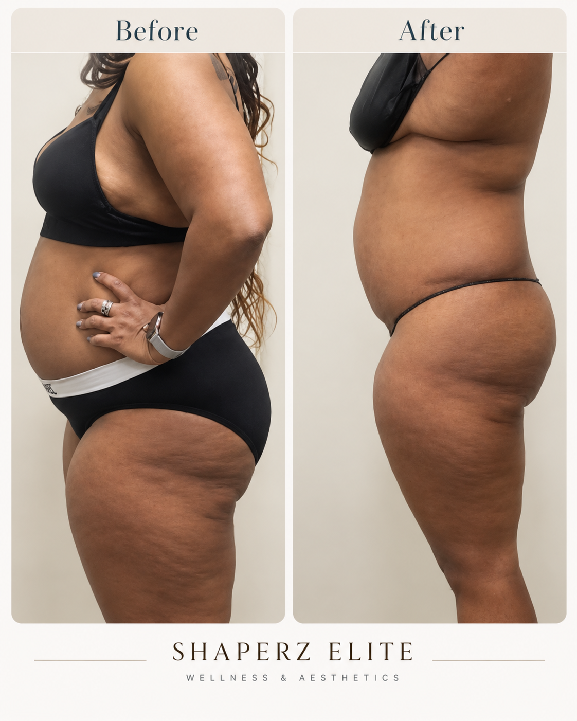 Body contouring before and after, side view of the waist, abdomen and flank at Shaperz Elite Wellness in Chicago