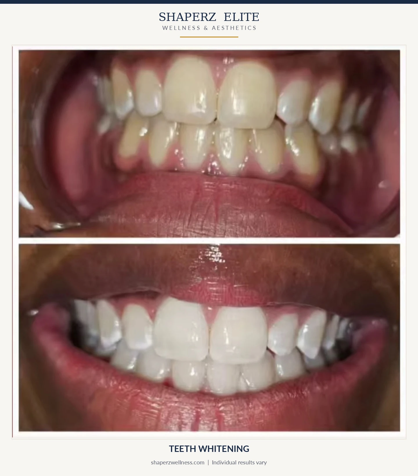 Professional teeth whitening before and after at Shaperz Elite Wellness in Chicago