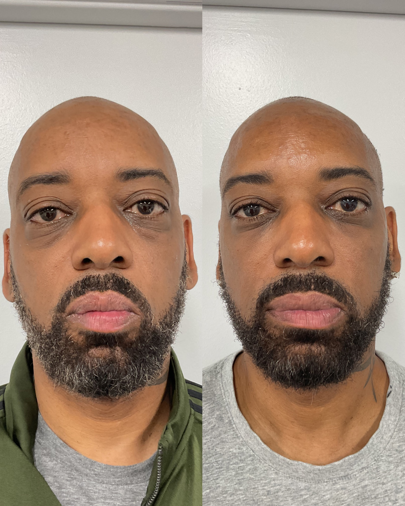 Male filler before and after treating the under-eye and mid face at Shaperz Elite Wellness in Chicago