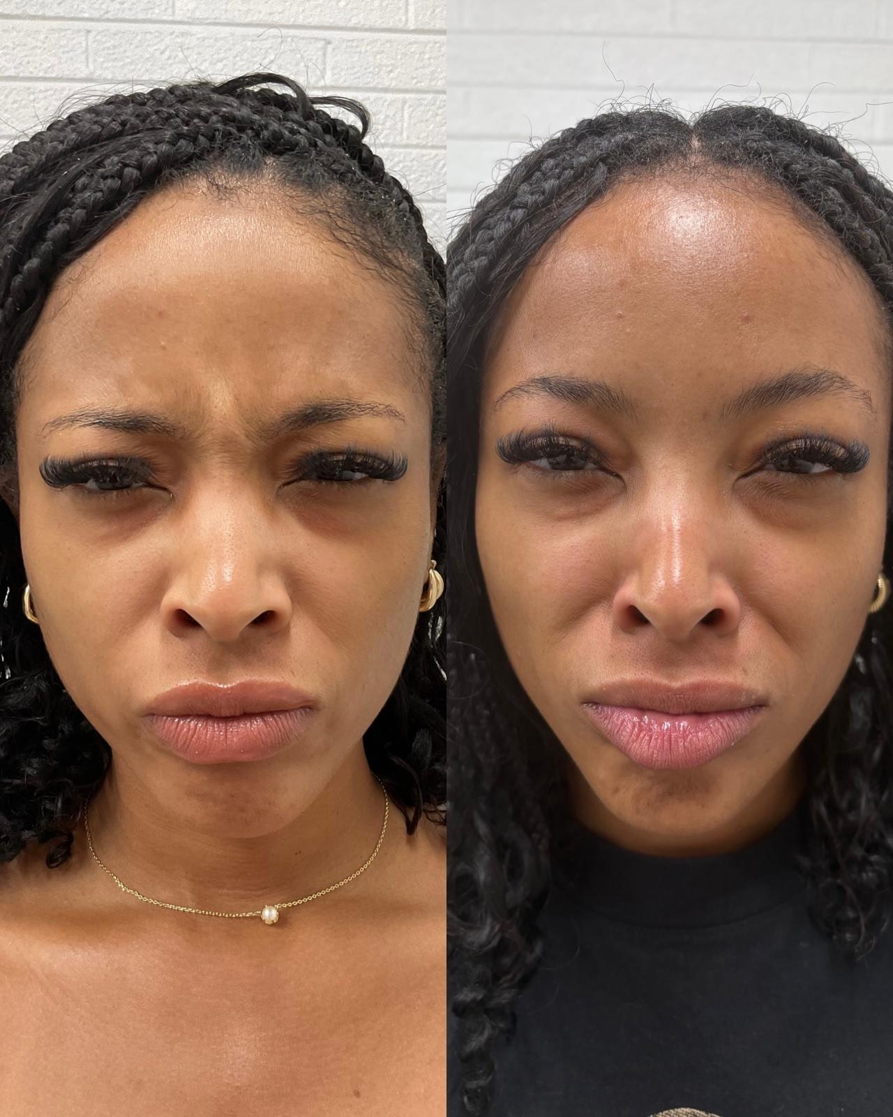 Xeomin before and after with a smoother, refreshed look at Shaperz Elite Wellness in Chicago