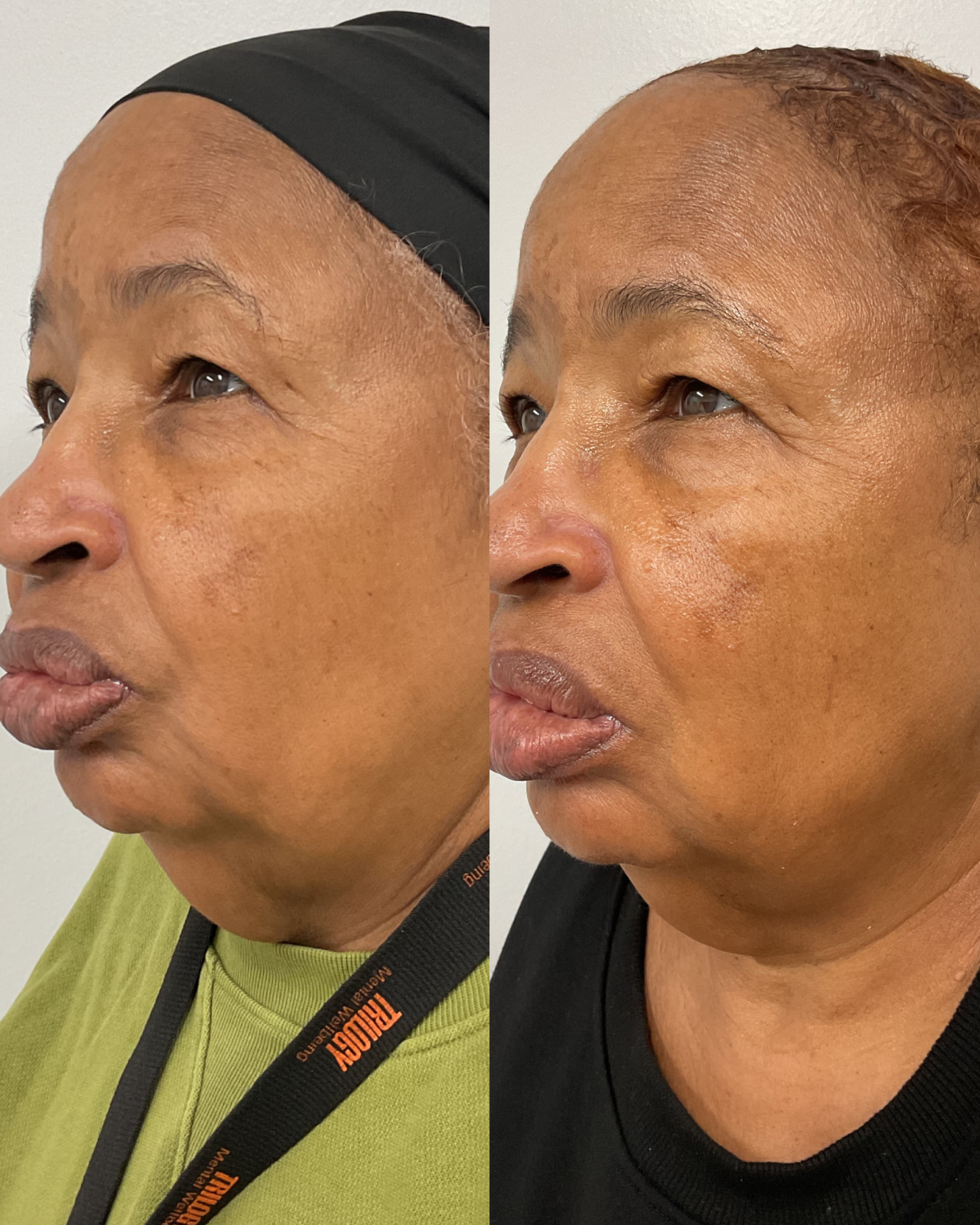 LipoDissolve and skin tightening before and after, profile view, treating a double chin at Shaperz Elite Wellness in Chicago