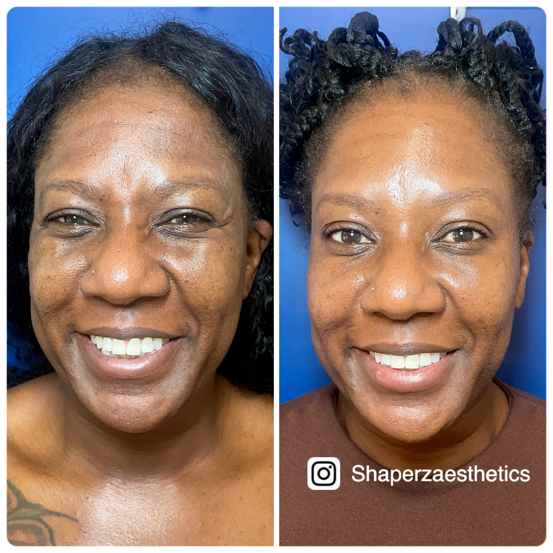 Neuromodulator before and after with a smoother, refreshed look at Shaperz Elite Wellness in Chicago