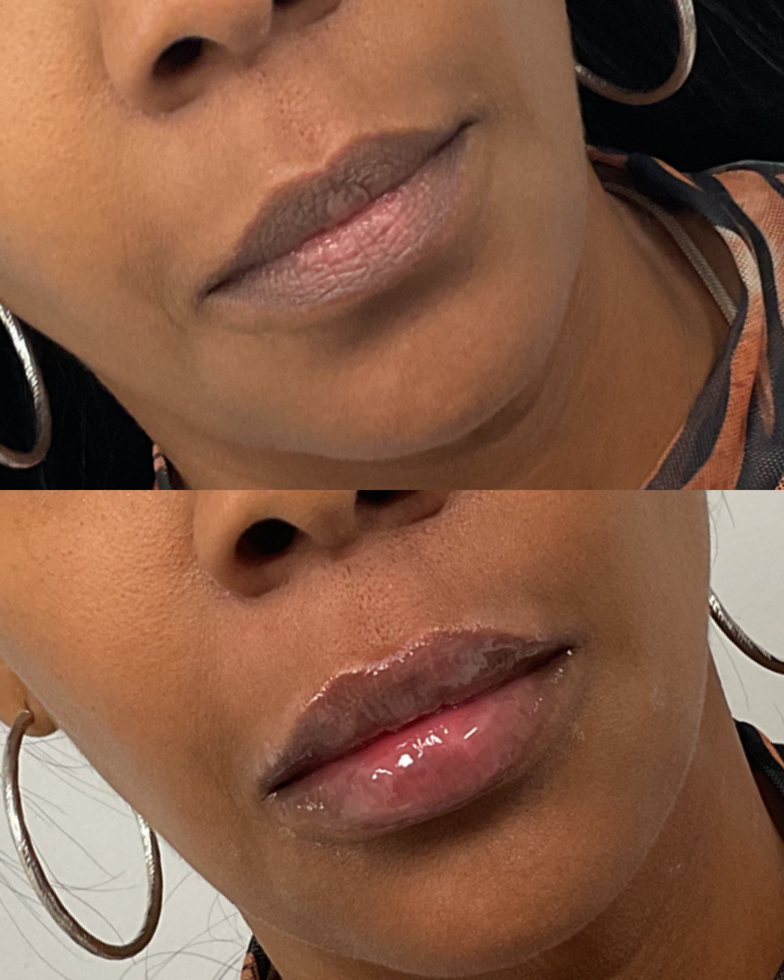 Lip filler before and after, front view, at Shaperz Elite Wellness in Chicago