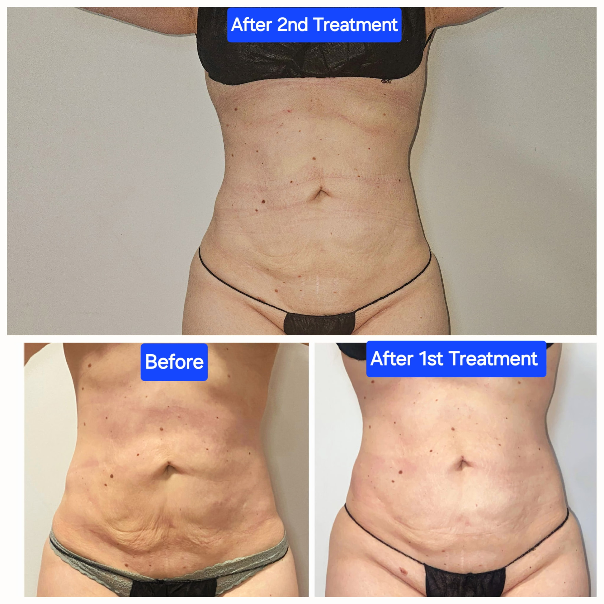 LipoDissolve before, after first treatment and after second treatment on the abdomen at Shaperz Elite Wellness in Chicago