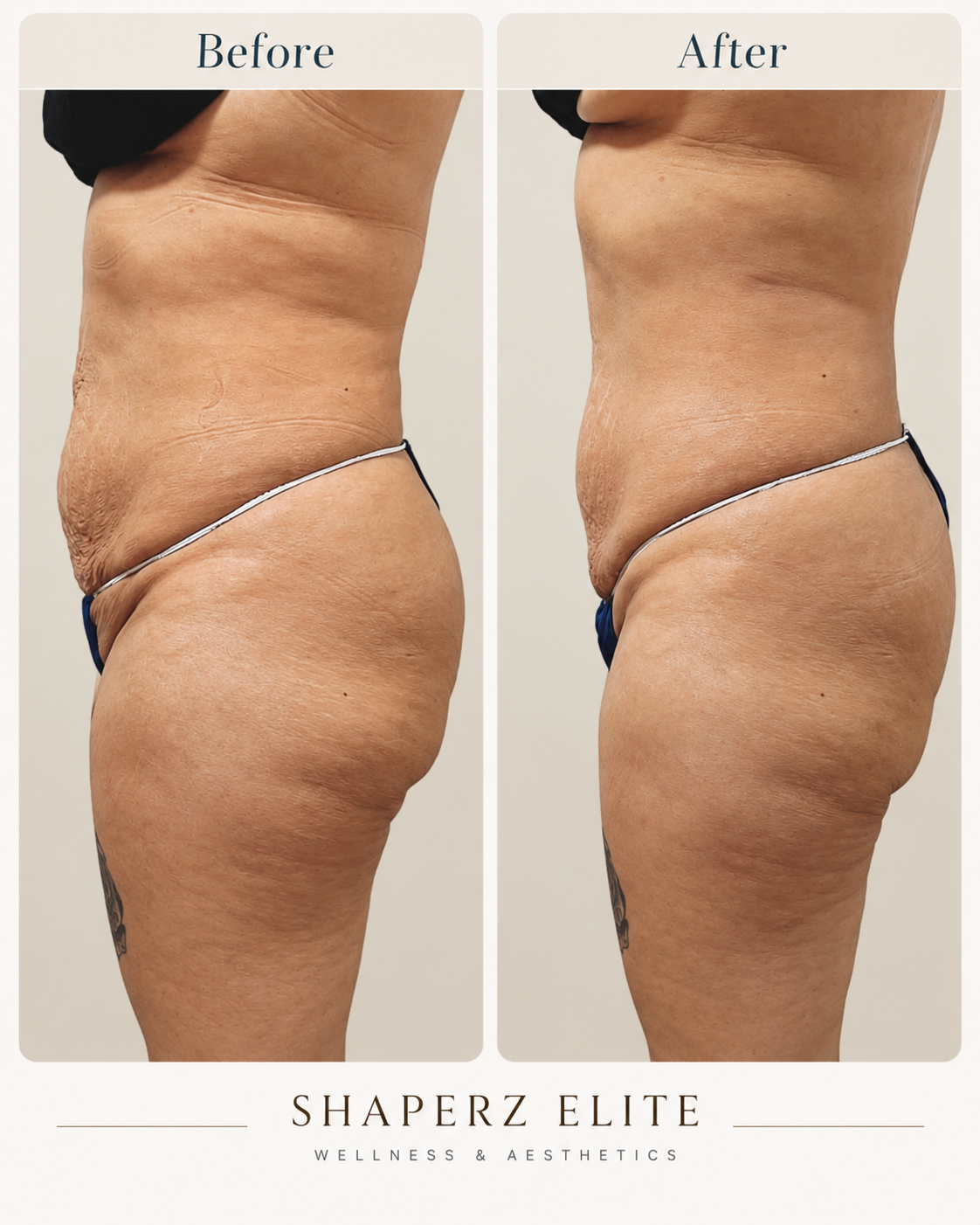 Body contouring before and after, side view of the abdomen and flank at Shaperz Elite Wellness in Chicago