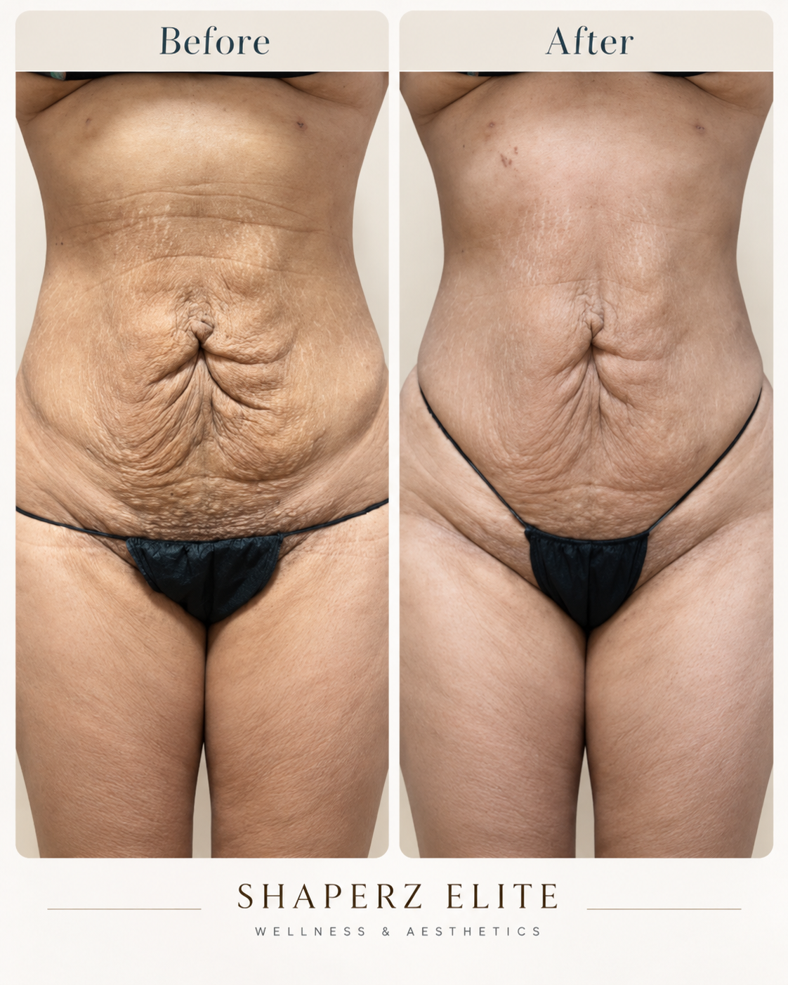 Body contouring before and after, front view of the abdomen at Shaperz Elite Wellness in Chicago