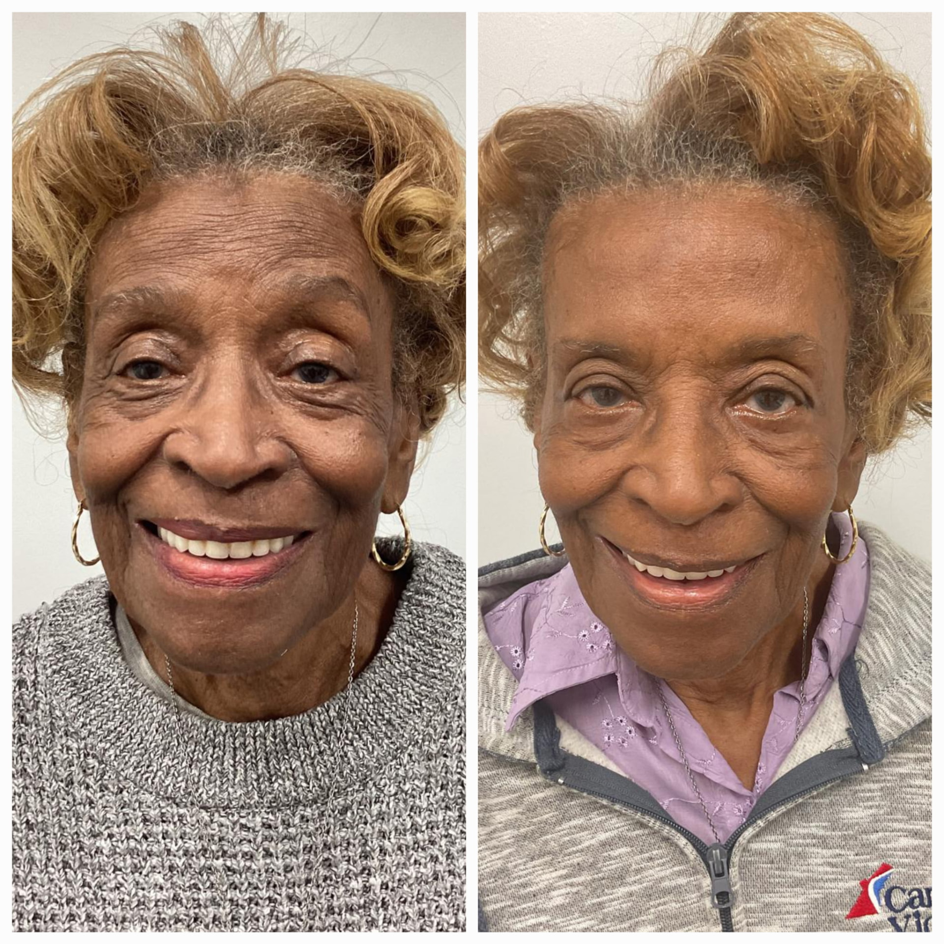 Xeomin before and after softening forehead lines at Shaperz Elite Wellness in Chicago