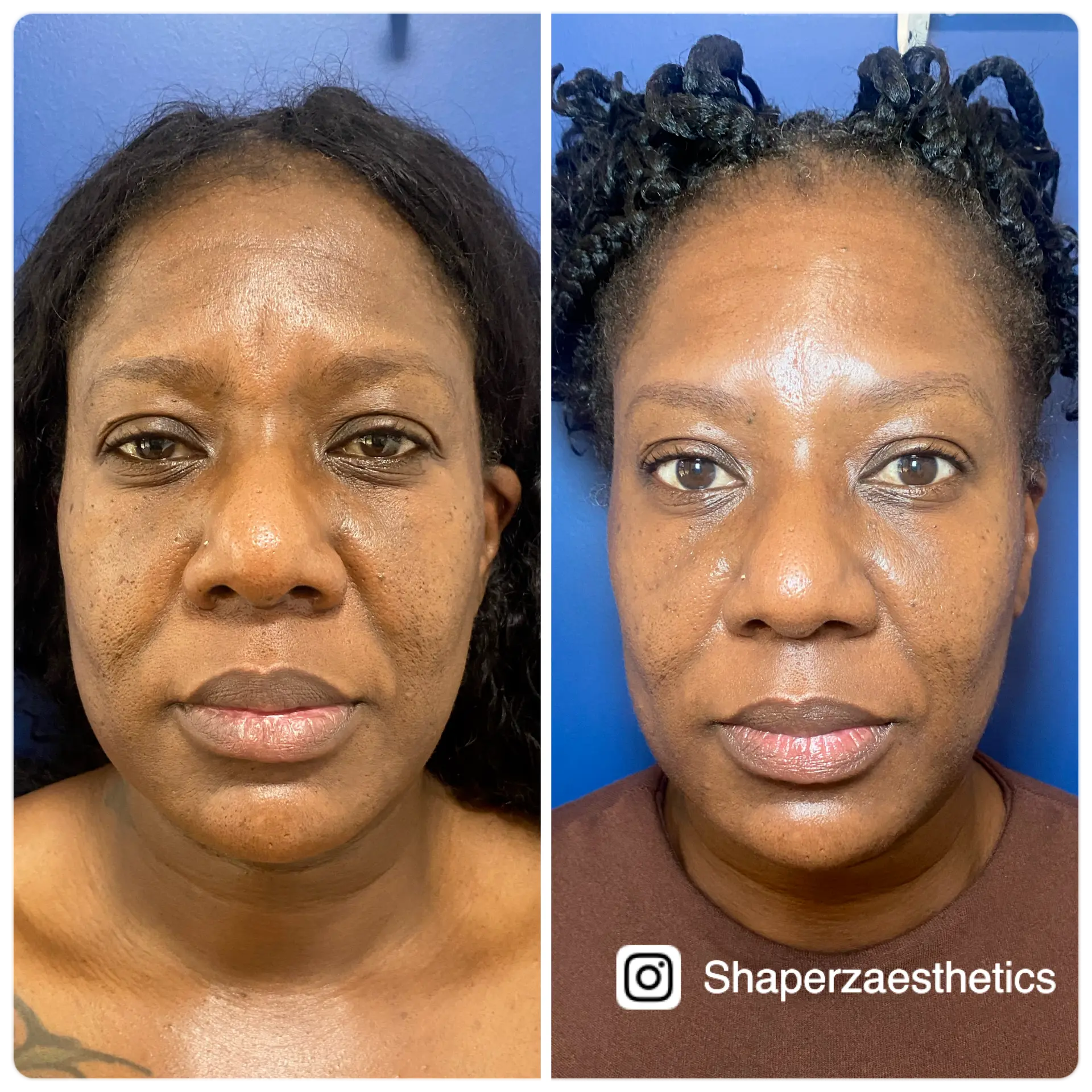 Neuromodulator before and after softening lines at Shaperz Elite Wellness in Chicago