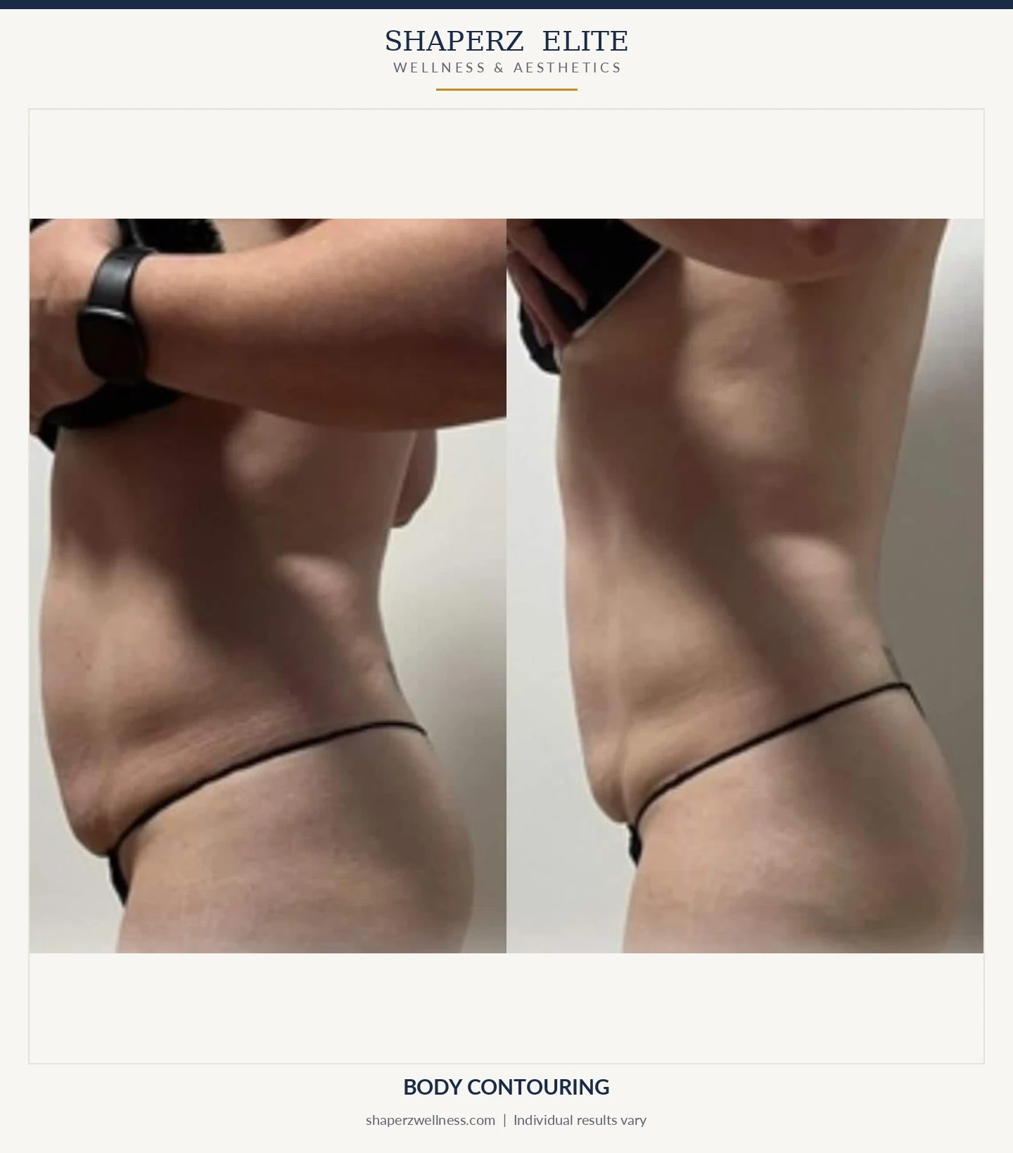 Body contouring before and after, side view of the waist and abdomen, at Shaperz Elite Wellness in Chicago