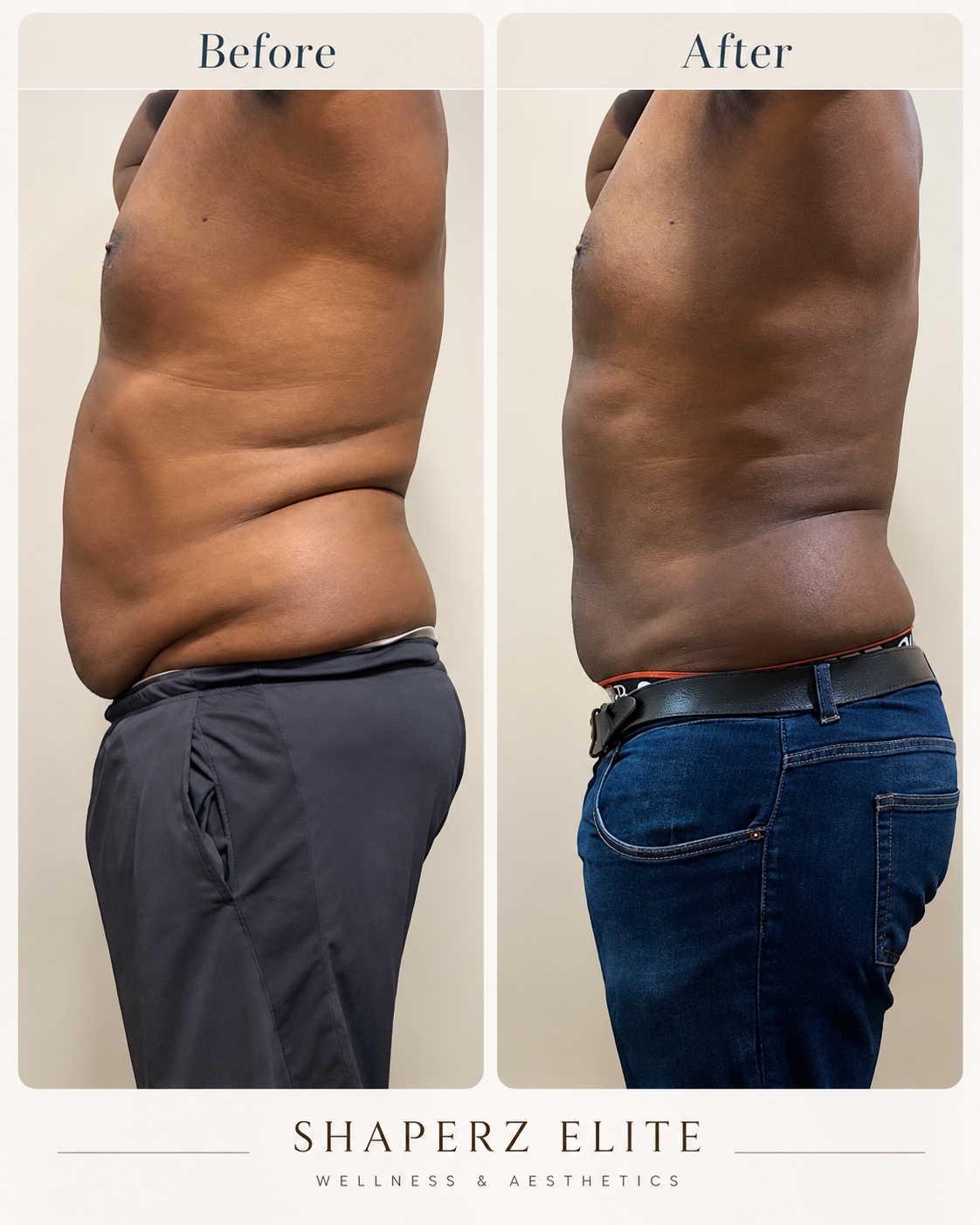 Body contouring before and after, side view of a male abdomen and flank at Shaperz Elite Wellness in Chicago