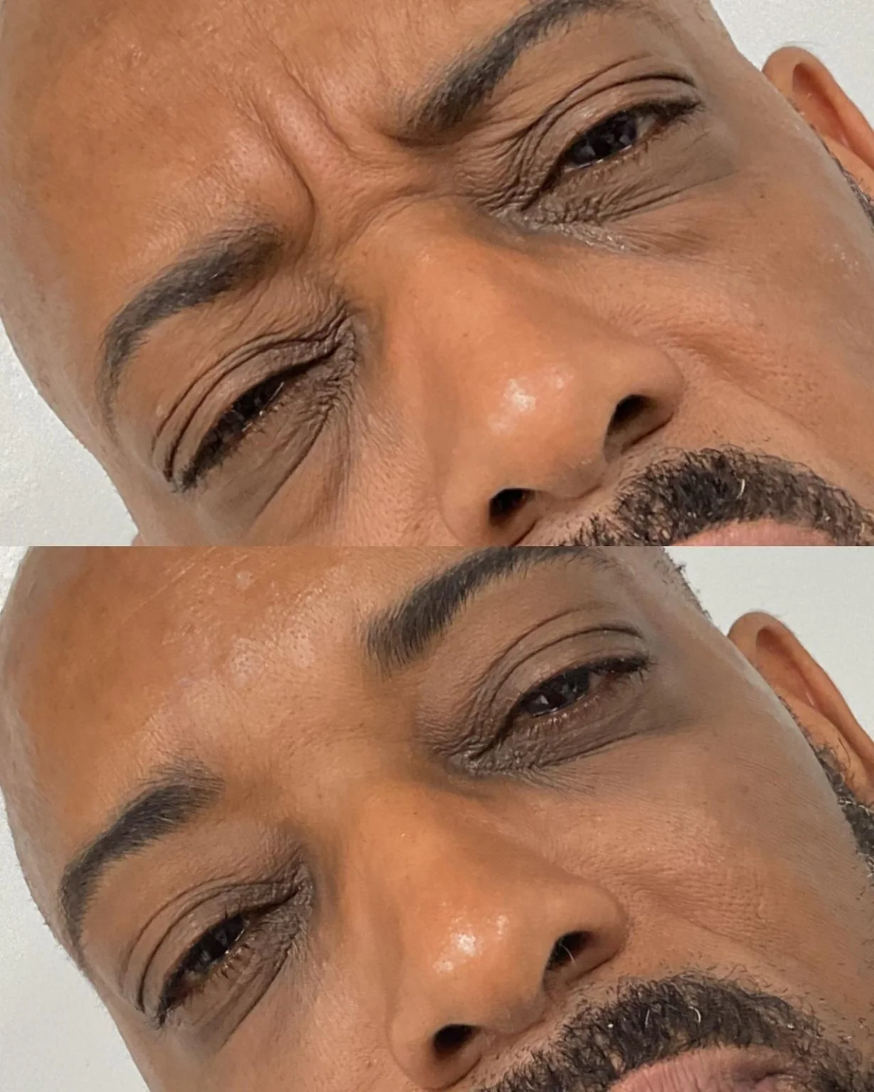 Male neuromodulator before and after softening frown lines between the brows at Shaperz Elite Wellness in Chicago