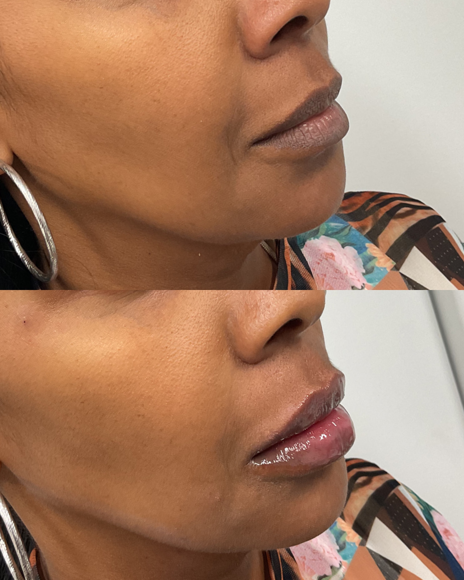 Lip filler before and after, profile view, at Shaperz Elite Wellness in Chicago