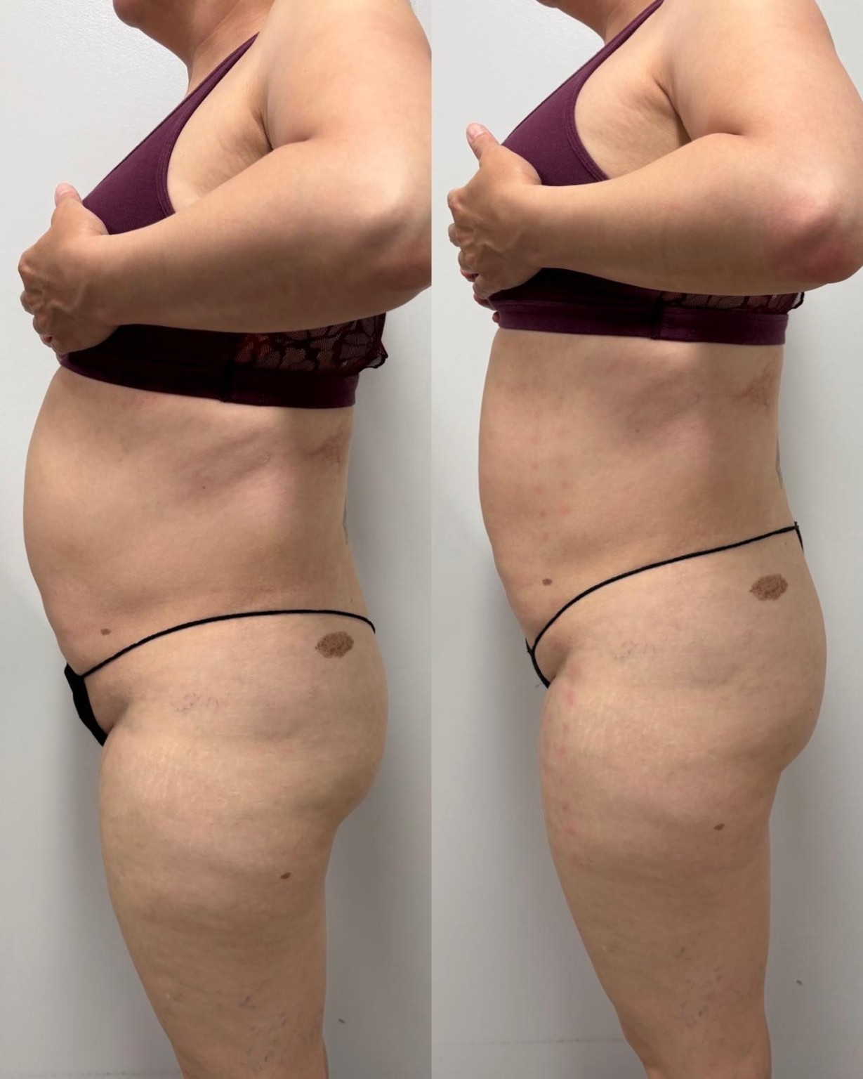 LipoDissolve before and after, side view of the abdomen, at Shaperz Elite Wellness in Chicago