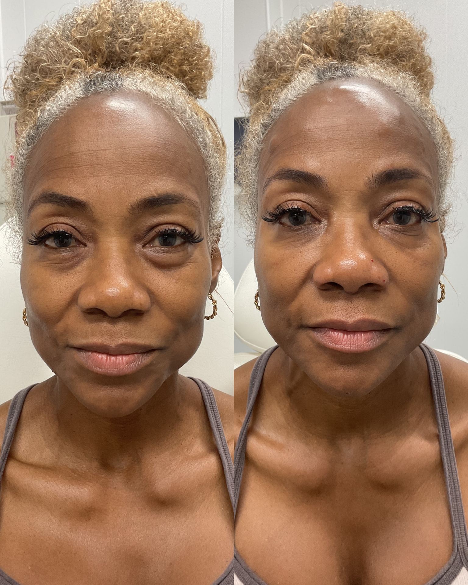 Dermal filler before and after treating the under-eye and mid face at Shaperz Elite Wellness in Chicago