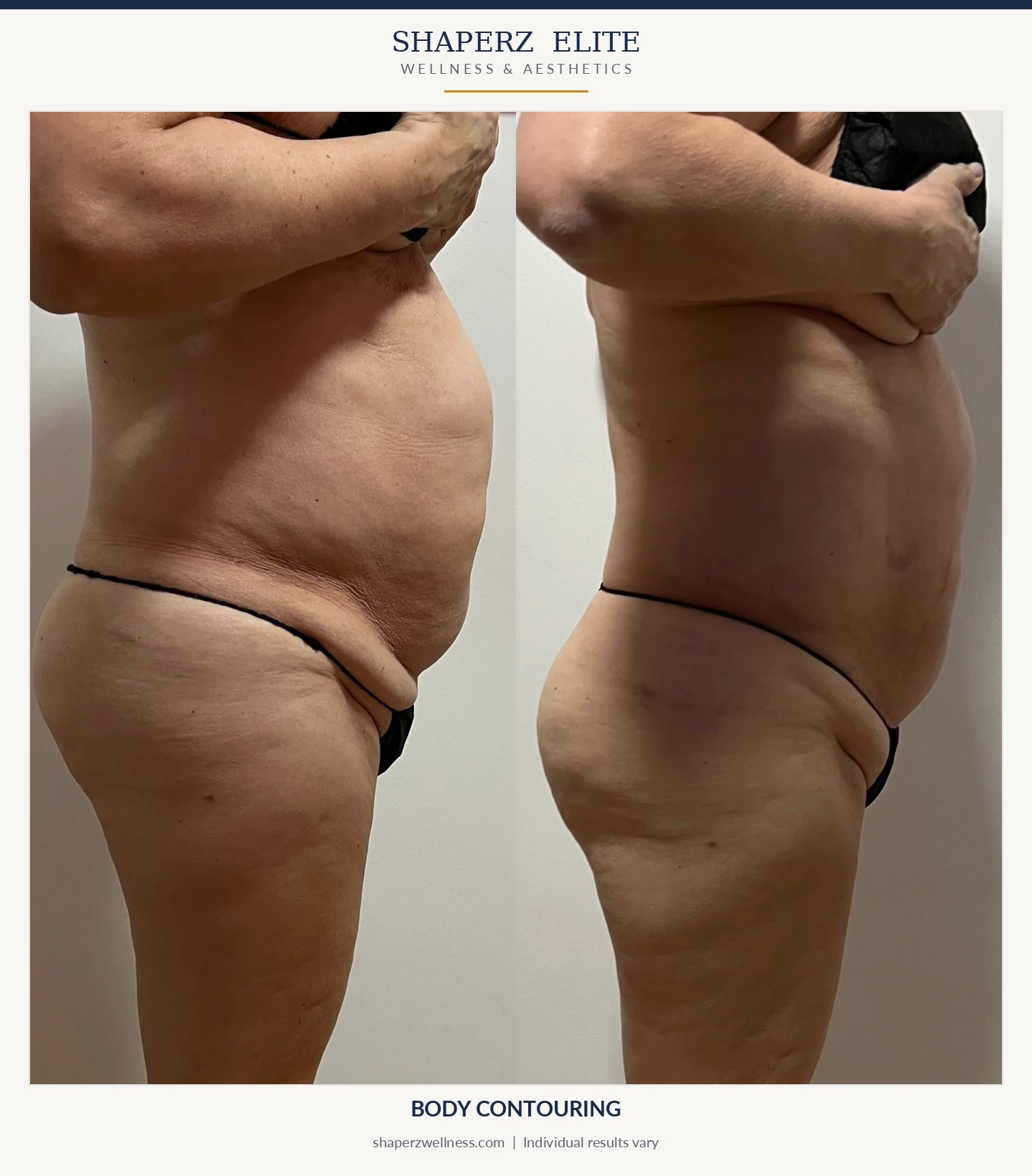 Body contouring before and after, side view of the abdomen, at Shaperz Elite Wellness in Chicago
