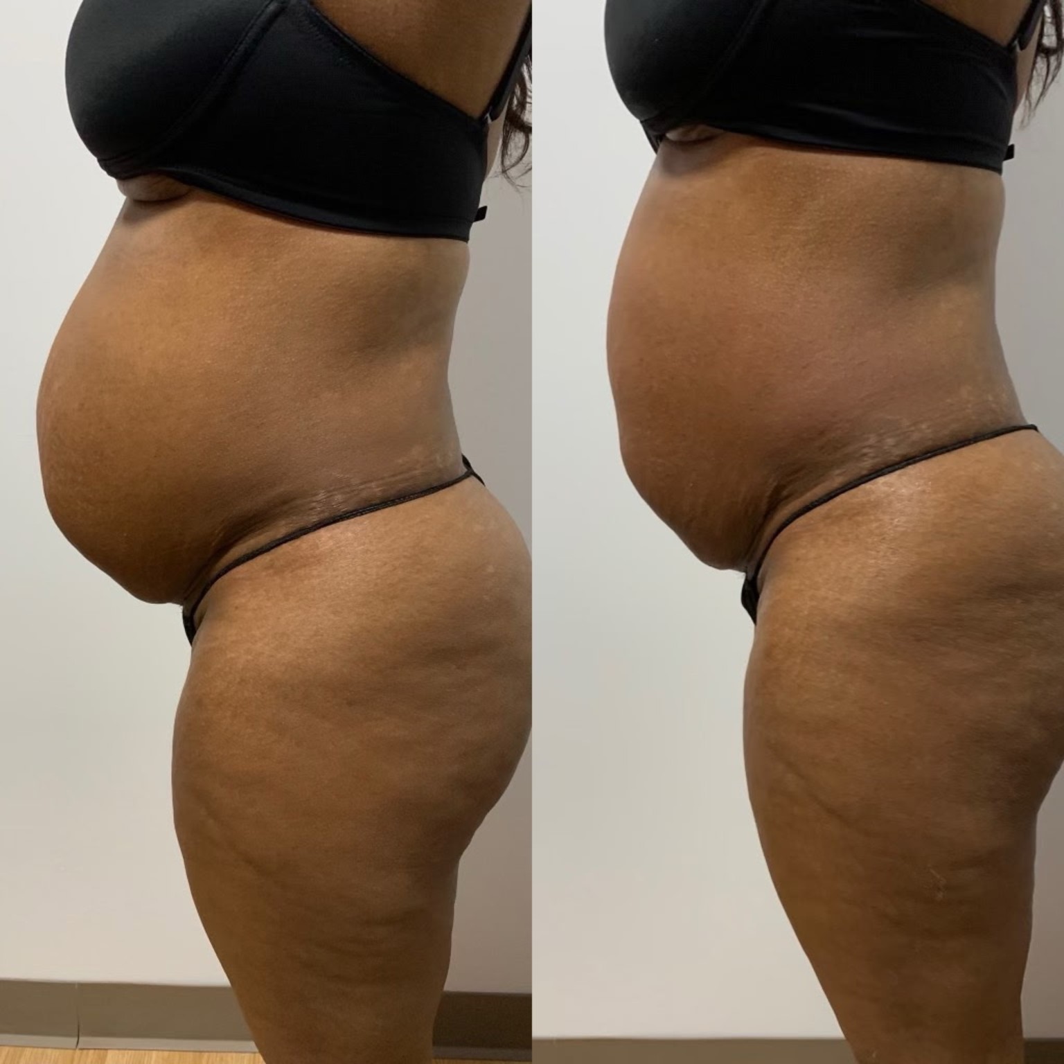 Body contouring before and after a single cavitation session, side view of the abdomen, at Shaperz Elite Wellness in Chicago