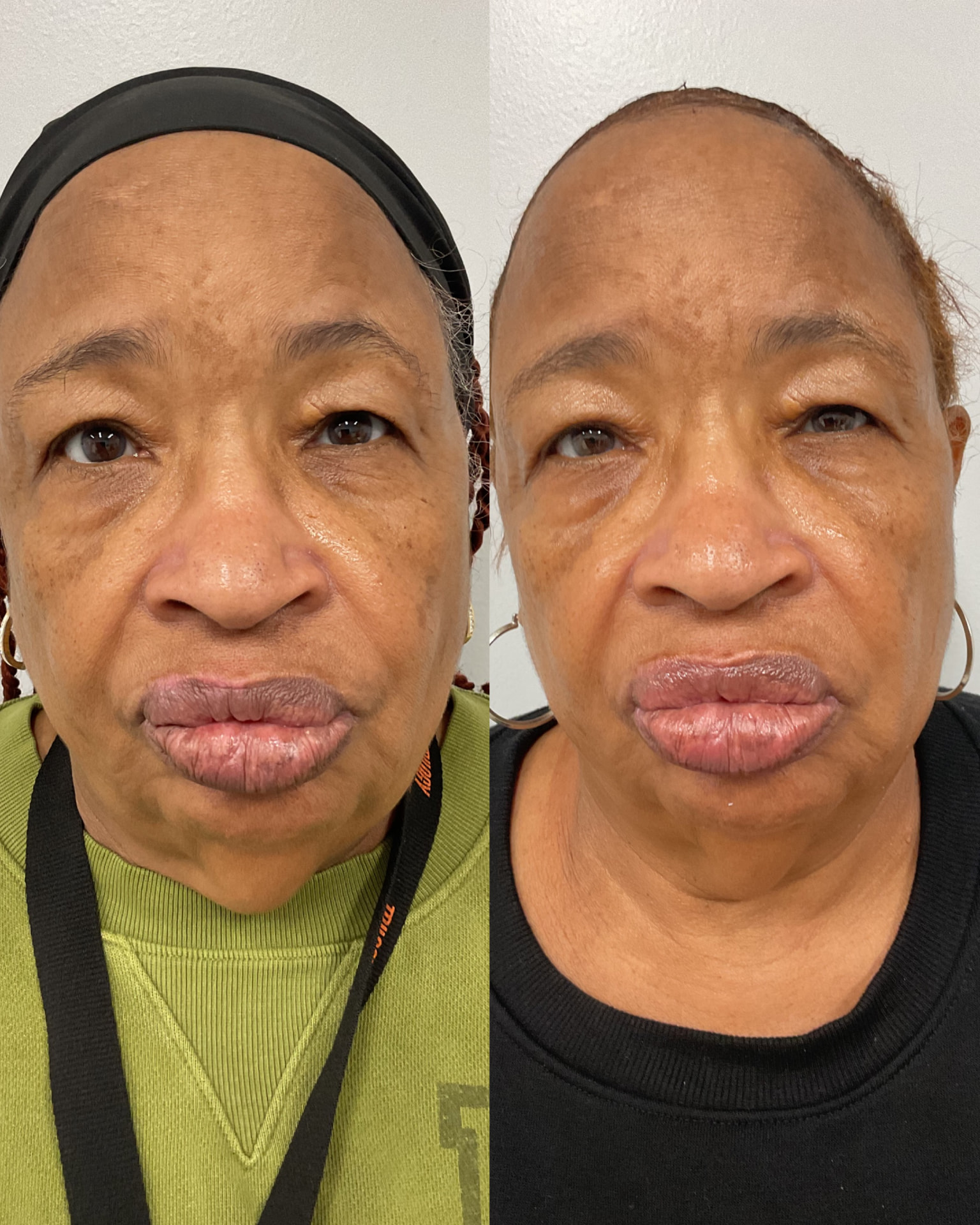 LipoDissolve and skin tightening before and after treating a double chin at Shaperz Elite Wellness in Chicago