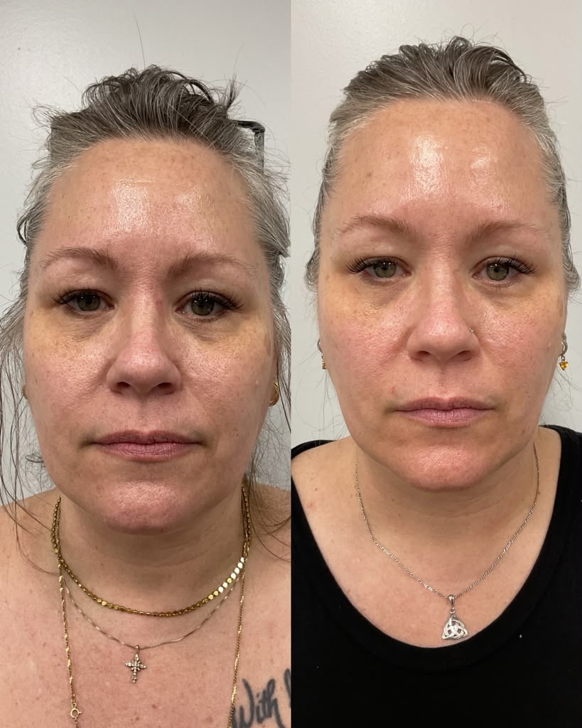 Xeomin before and after softening lines at Shaperz Elite Wellness in Chicago