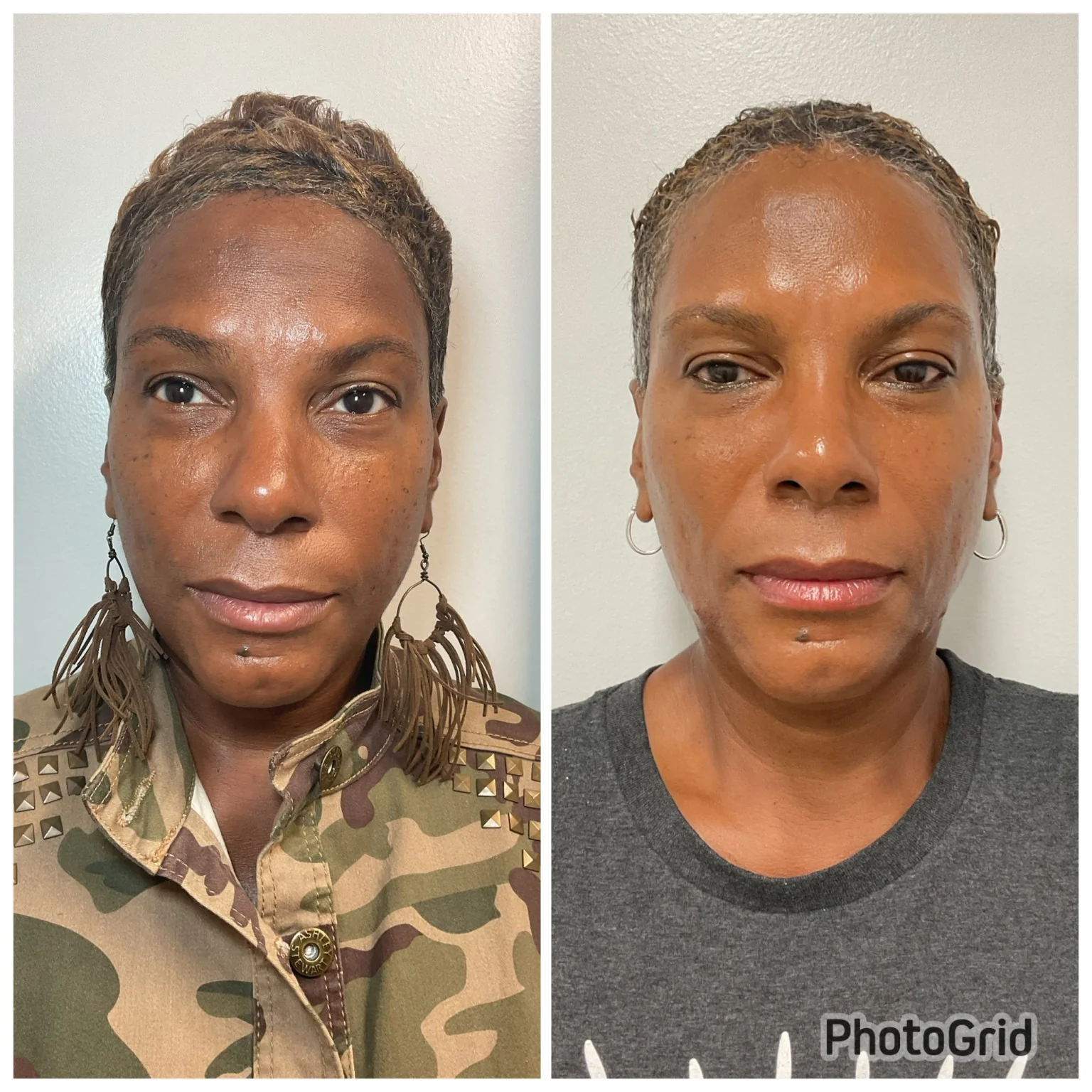 Platinum Customized Facial before and after showing brighter, more even skin at Shaperz Elite Wellness in Chicago