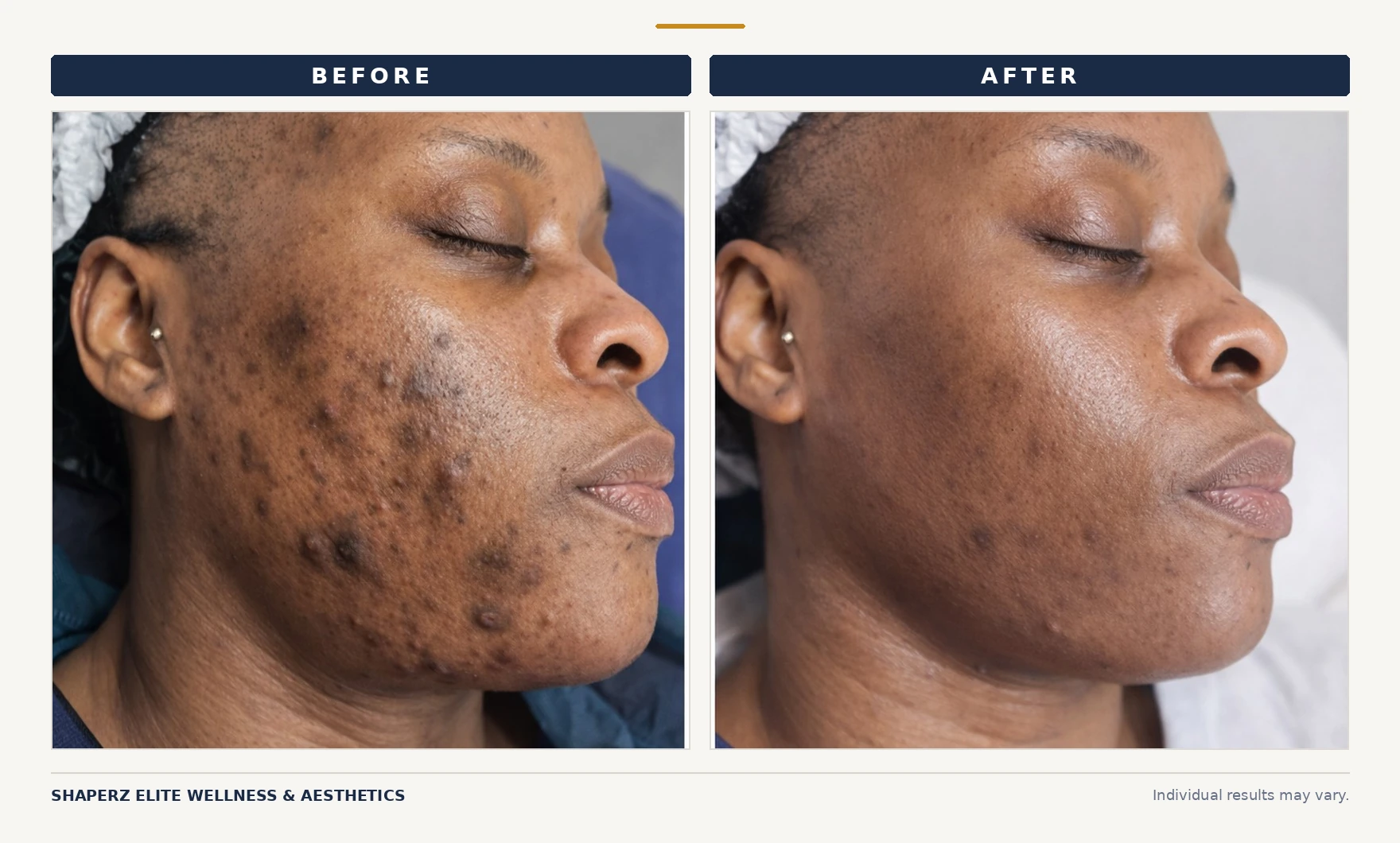 Chemical peel and microneedling acne treatment program before and after showing clearer, more even skin at Shaperz Elite Wellness in Chicago