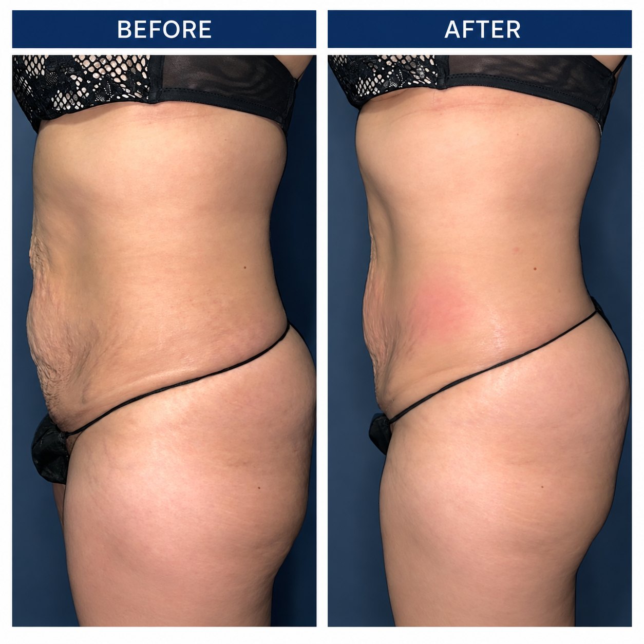 Body contouring before and after, side view of the abdomen at Shaperz Elite Wellness in Chicago