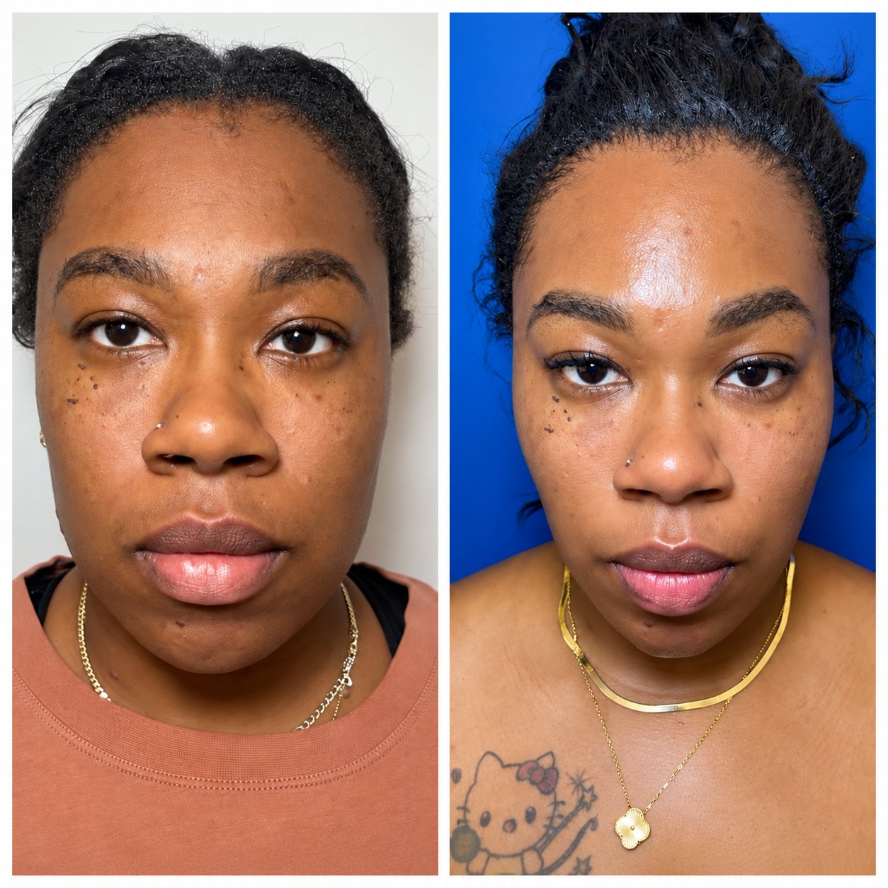 Full facial balancing before and after at Shaperz Elite Wellness in Chicago