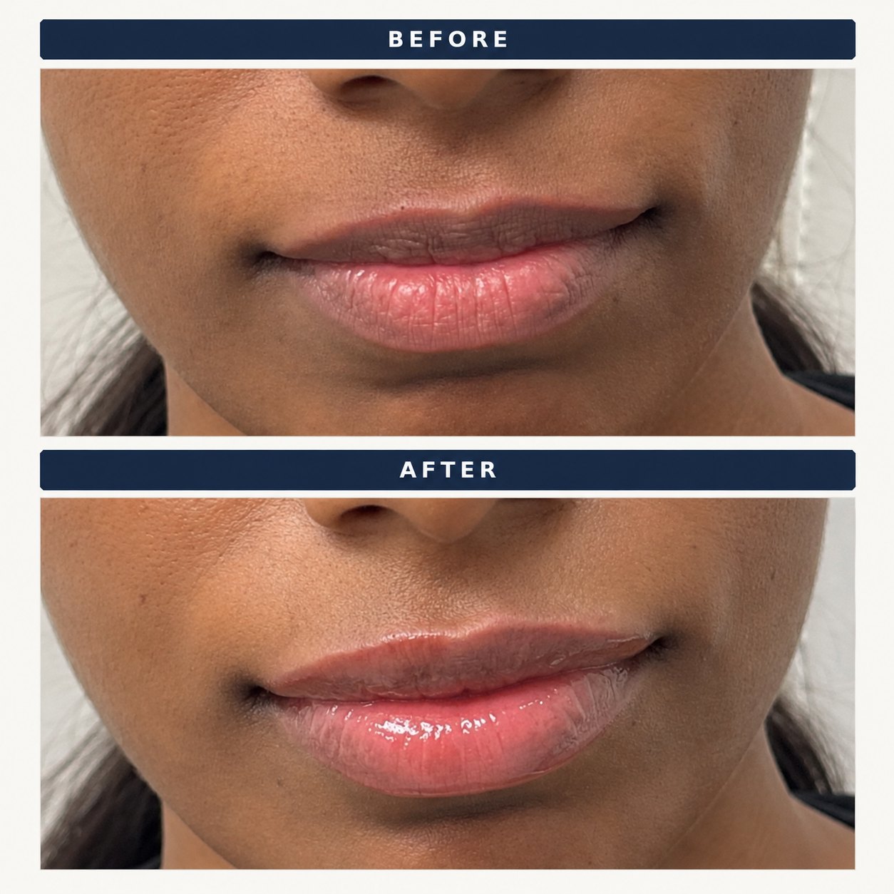 Half a syringe of lip filler with a lip flip before and after at Shaperz Elite Wellness in Chicago