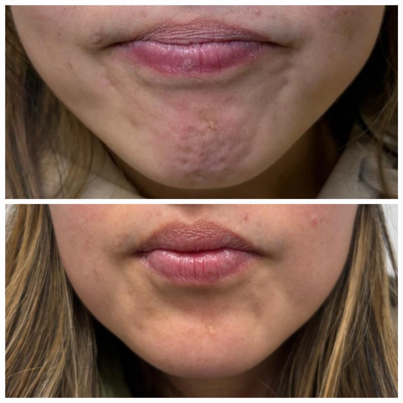 Mentalis tox, also known as chin tox, before and after at Shaperz Elite Wellness in Chicago