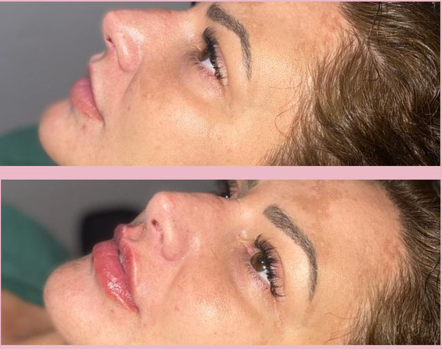 Close view of balanced lip filler results at Shaperz